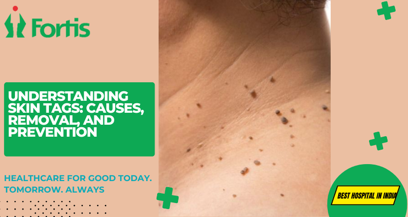 Understanding Skin Tags: Causes, Removal, and Prevention